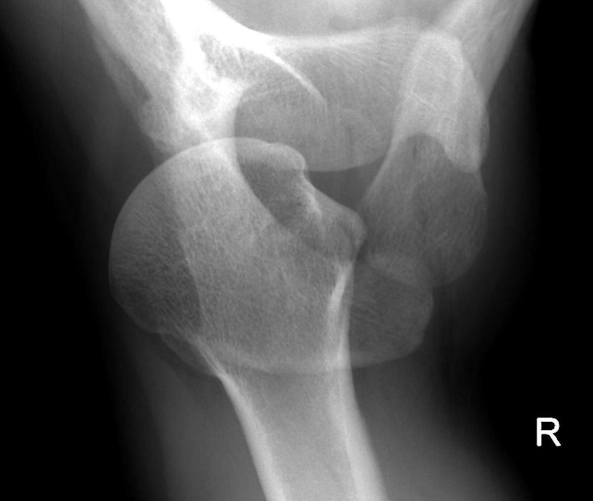 Posterior Shoulder Dislocation Axillary Lateral